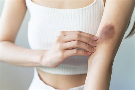 Bruising Prevention and Healing After a Blood Draw - Phlebotomy USA