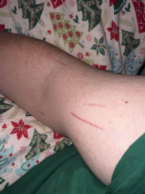 Burst blood vessels in arm from Blood Pressure Cuff : r/medical