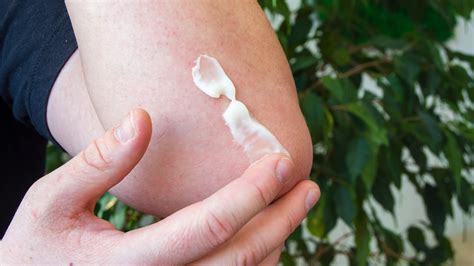 12 Ways to Soothe and Treat Mosquito Bites - GoodRx