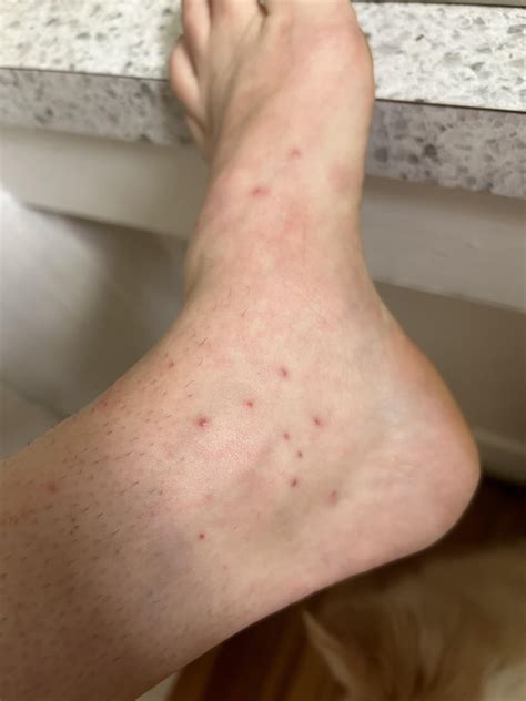 Rash on feet with unexplained severe body aches and swollen face : r/DiagnoseMe