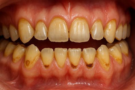 Molar Erosion Gastro Esophageal Reflux Disease (GERD) & Tooth Erosion