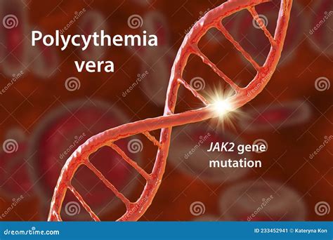 Polycythemia Vera, a Rare Slow-growing Blood Cancer with an Increase in the Number of Red Blood ...