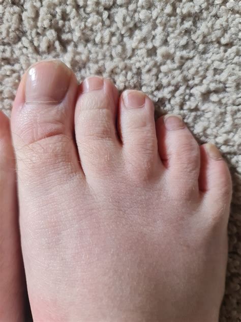 Introduction to my webbed toes and feet. Left foot is more webbed then the right. - Fun With Feet