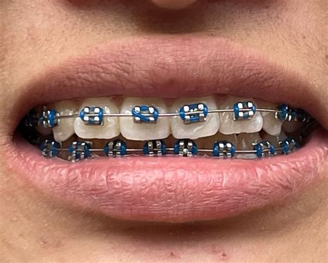 23 ideas de Brackets | brackets, ligas brakets, frenillos dentales