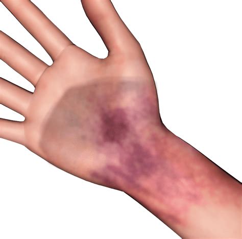 Pasa In English Bruise at Marva Owens blog