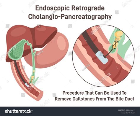 71 Cholangiopancreatography Ercp Images, Stock Photos & Vectors | Shutterstock
