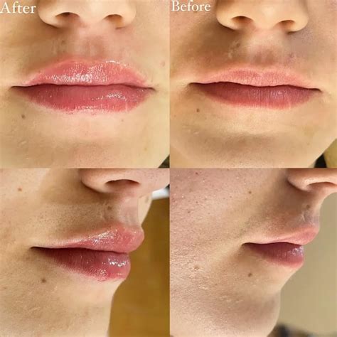 Lip Filler Before and After - Before After Journey