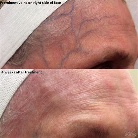 Spider Veins Treatment: Non-Invasive Therapy Cost in Issaquah