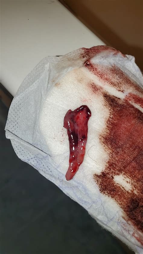 Uterine Lining Versus Blood Clots During Period