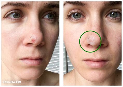 Skin Cancer On Nose Pics