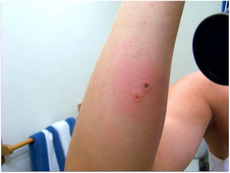 Centipede Bites On Humans