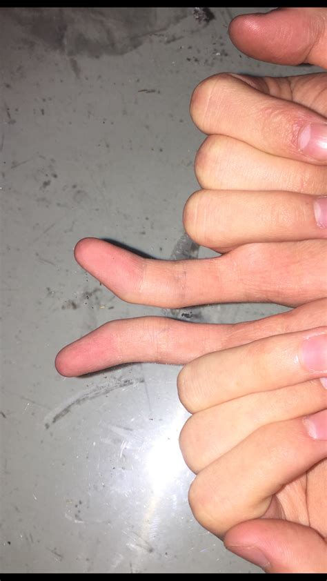 Little Finger Crooked