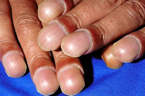 Clubbed Fingers: What Causes Clubbed Fingers and Thumbs?
