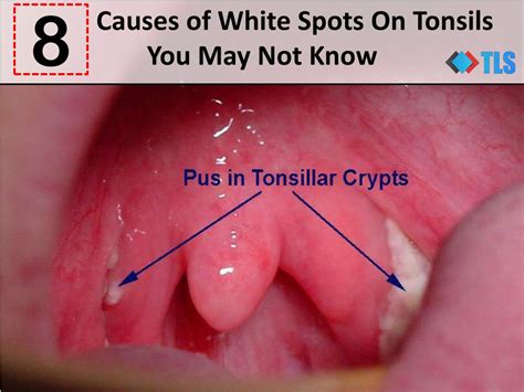 PPT - 8 Causes of White Spots On Tonsils You May Not Know PowerPoint Presentation - ID:7321615