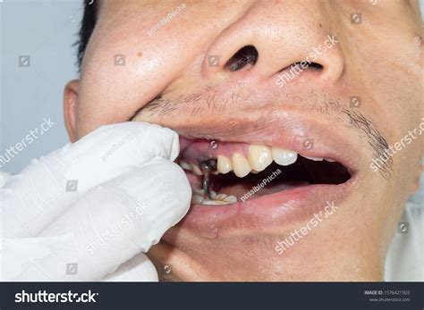 Remove Teeth Decay: Over 1,783 Royalty-Free Licensable Stock Photos | Shutterstock