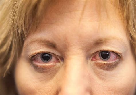 Eyes Dilated Meaning Drugs at Dina Mcalpin blog