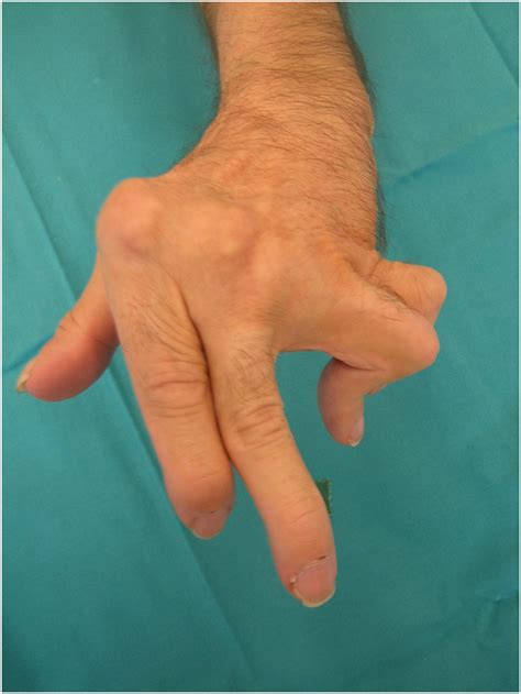 Swan-Neck and Boutonniere Deformity in Rheumatoid Hand - Hand Clinics