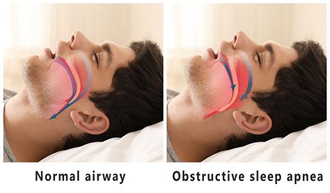 Sleep Apnea Facial Structure at David Buckley blog