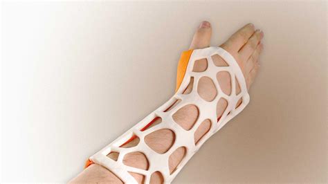 Russian Company Looks to Bring 3D Printed Casts to Market - 3DPrint.com ...