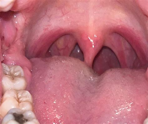 Canker Sore On Tonsil