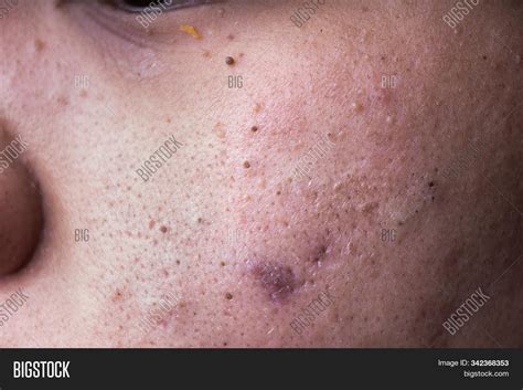 Blackhead On Cheek