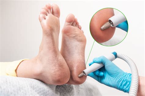Callus, Corn, and Bunion Treatment | Singleton Podiatry