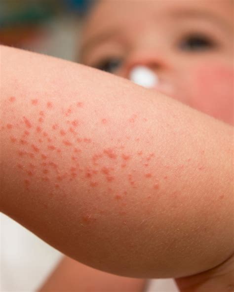 Heat rash in children — THE PEDIATRICIAN MOM
