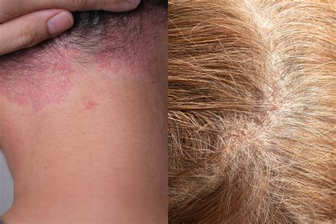 Eczema Hairline My Scalp Psoriasis Came Out Of Nowhere — Here's How