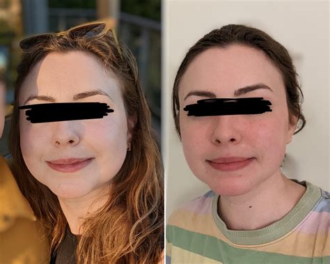 9 Weeks Post-Op Buccal fat removal, jaw and face lipo, and neck lift : r/PlasticSurgery
