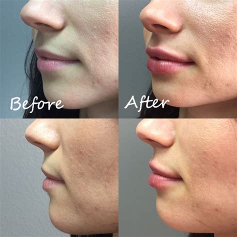 Lip Botox Injections at Timothy Simpson blog