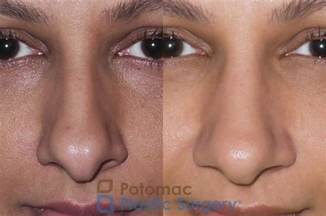 Septoplasty And Turbinate Reduction Before And After