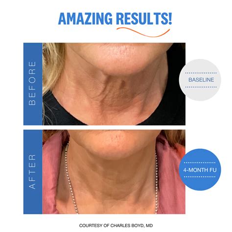 Sofwave™ Treatment | Bellevue & Kirkland, WA | Lifted Beauty & Wellness