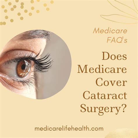 Does Medicare Cover Cataract Surgery - Medicare Life Health