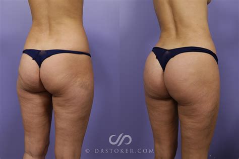 Butt Fat Transplant