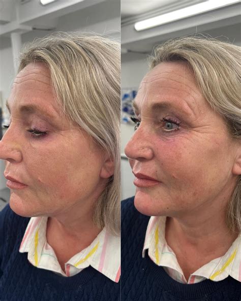 Transformations: Anti-Wrinkle and Dermal Fillers Before and After