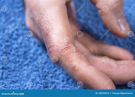 Cracked, Flaky Skin on the Palm of Your Hand. Dermatological Problems of Psoriasis. Stock Photo ...