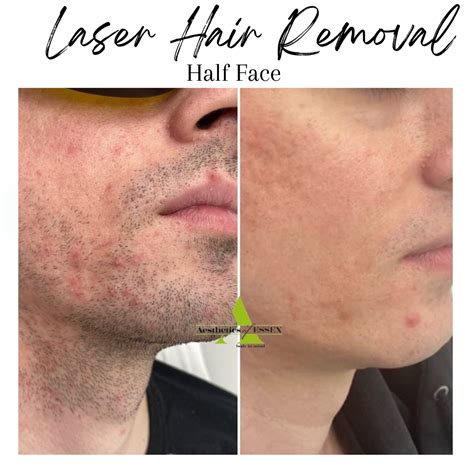Laser hair removal chin new arrivals