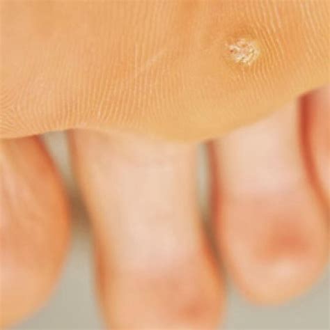 Start Of Plantar Wart | Plantar warts: Symptoms, causes, and treatment – EEUVG