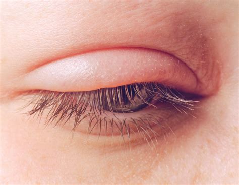 Blepharitis - Lighthouse Guild