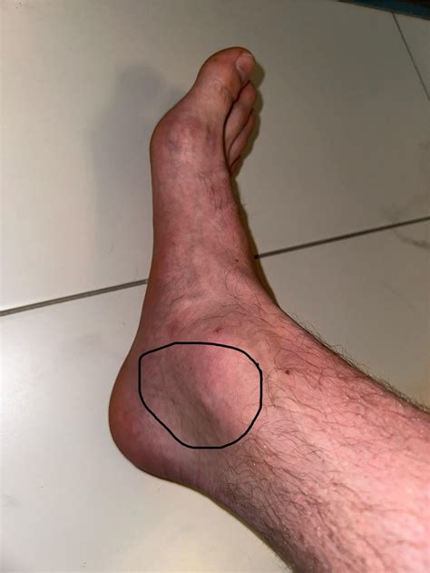 Medial Ankle Sprain