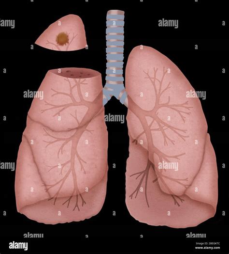 Lingula In Lungs