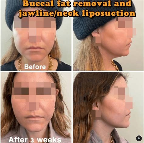 Buccal Fat Pad Removal - Harley Clinic