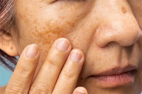 What is Melasma on Face? Causes & Treatment | OneSkin