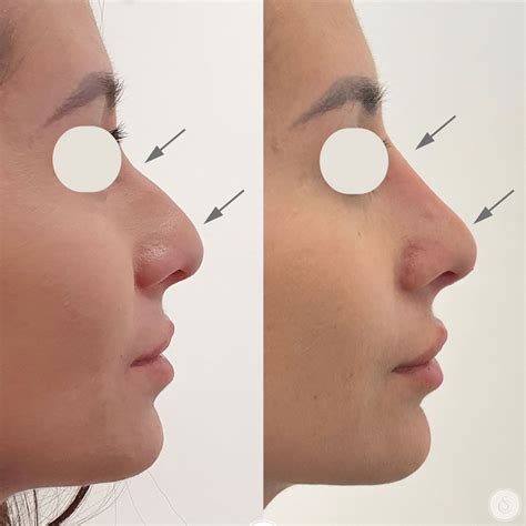 Filler nose: for a rhinoplasty without surgery | Sarasin Clinic