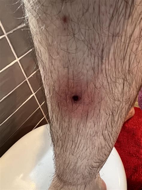 Strange red pimple on leg with black crust in the middle : r ...