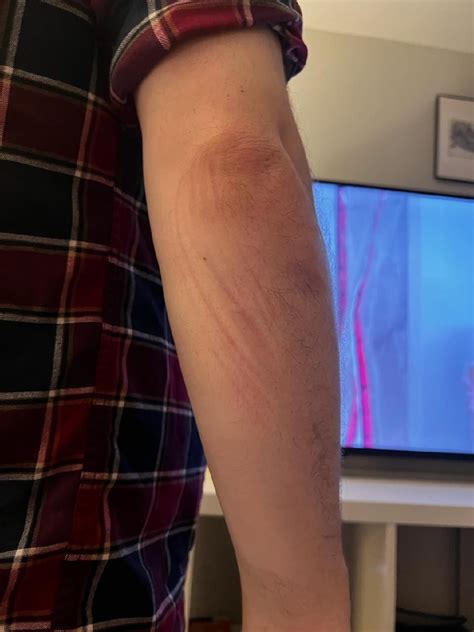 What are these indents/lines on my arm? : r/Dermatology