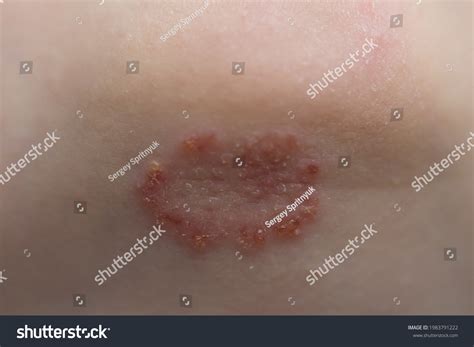 Rash On Childs Chin Form Pimples Stock Photo 1983791222 | Shutterstock