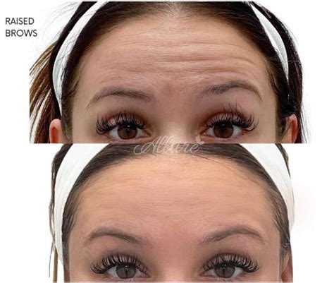 What is Dysport? | Powerful Botox Alternatives (2025)