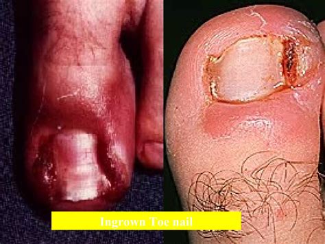 Toe Nail Avulsion