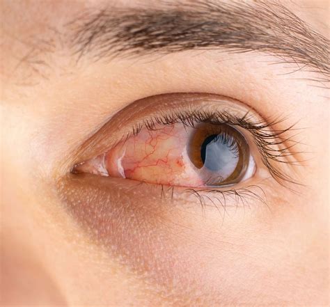 Seasonal Allergies And Conjunctivitis: Minimizing Discomfort And Finding Relief - Ask The Nurse ...